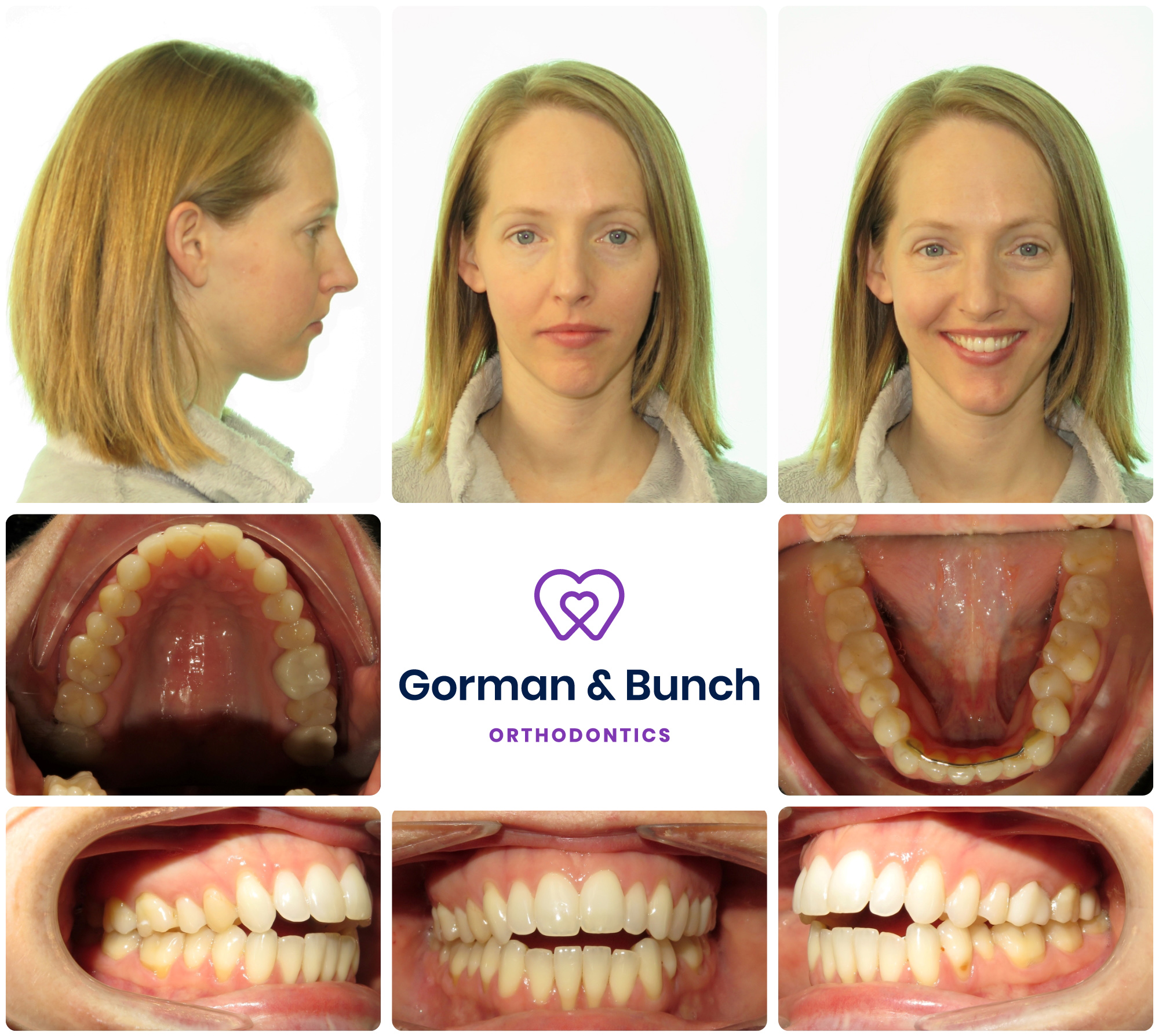 invisalign before and after - open bite - carmel indiana - hs - 1